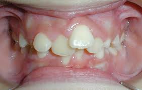 DIENTES_APIADOS.jpg